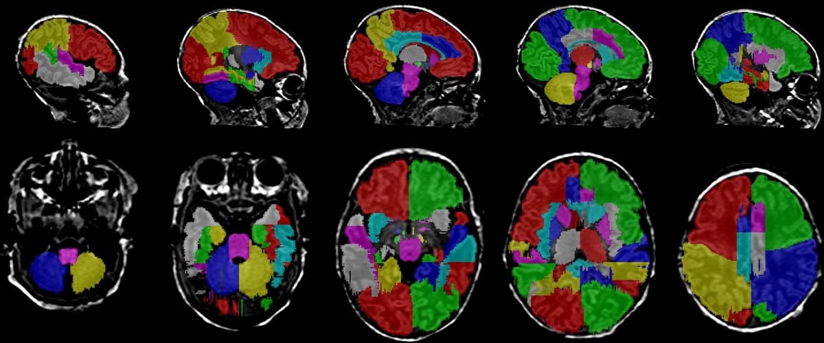 Brain MRI Segmentation Pipeline